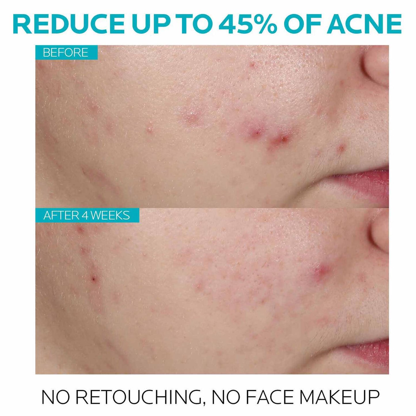 effaclar-salicylic-acid-acne-treatment-serum-i2 7_EffaclarSerum_After-45-days.jpg