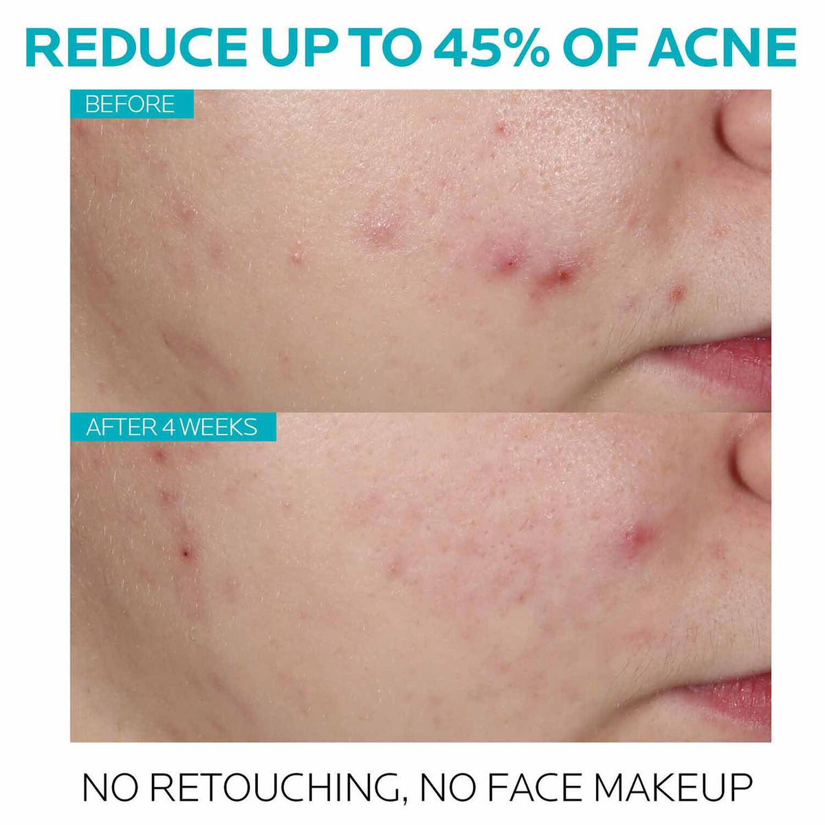 effaclar-salicylic-acid-acne-treatment-serum-i2 7_EffaclarSerum_After-45-days.jpg