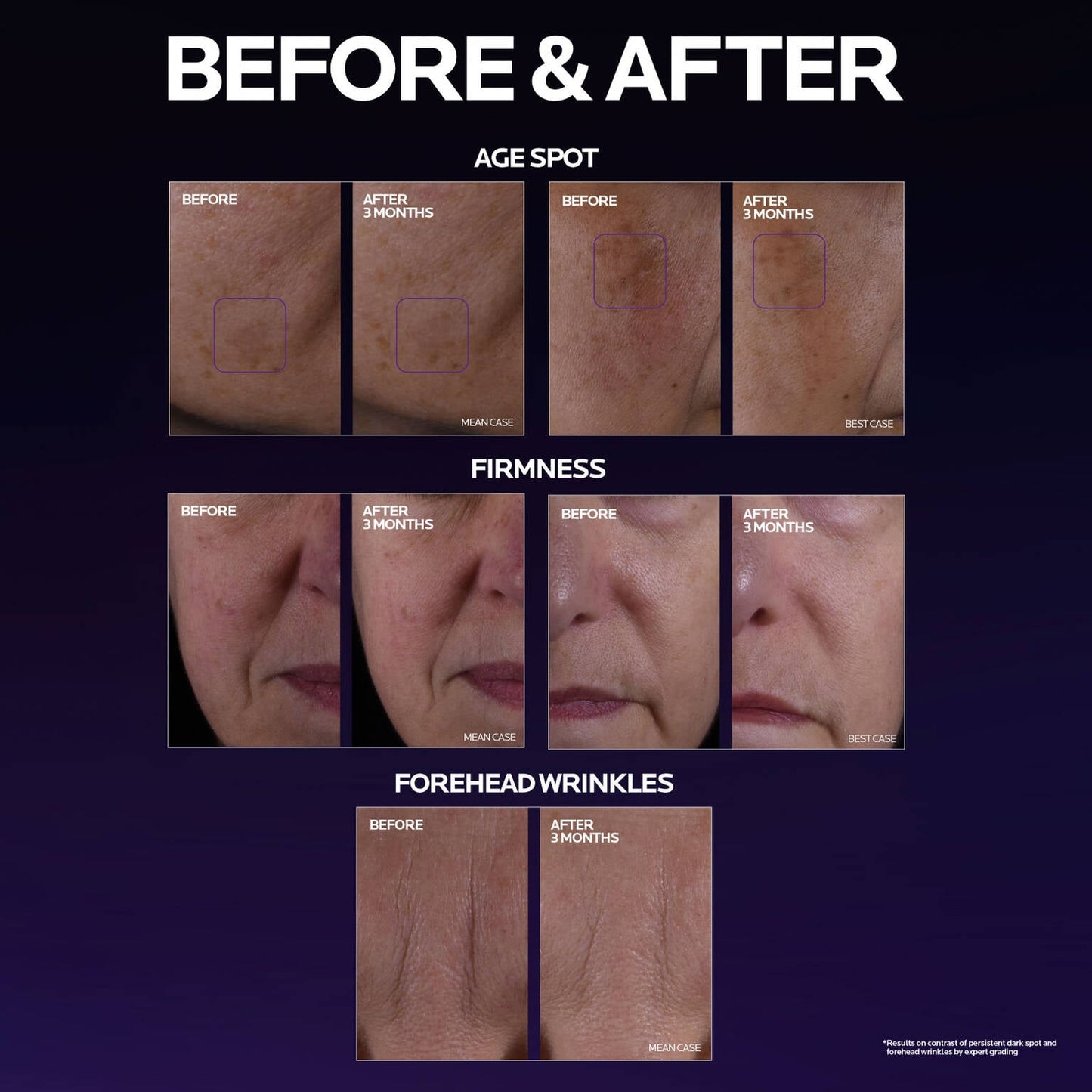 mela-b3-double-dose-discoloration-treatment-with-melasyltm-n9 MelaB3_DD_BTF_BeforeAfter_1500x1500_5.jpg