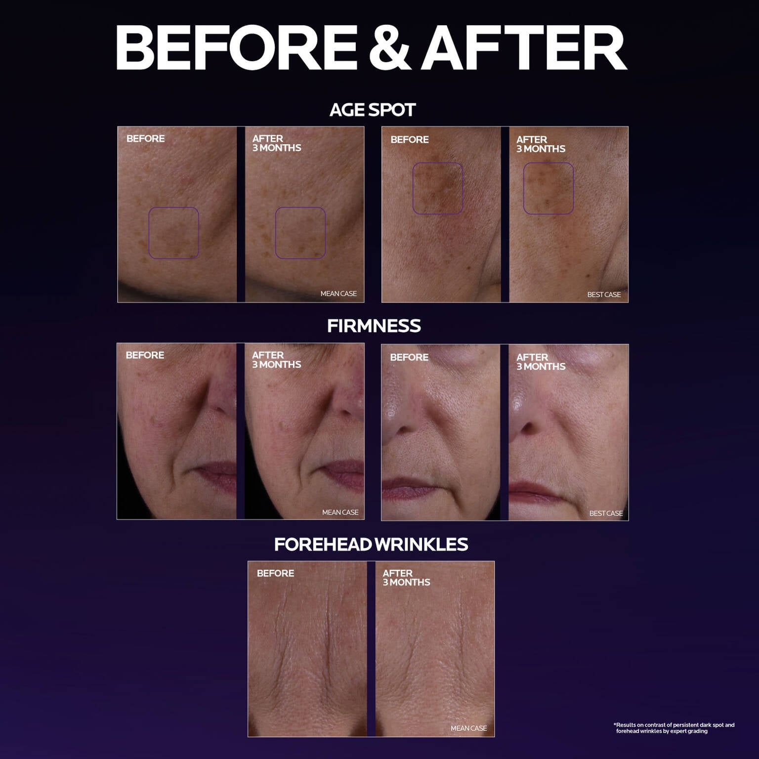 mela-b3-double-dose-discoloration-treatment-with-melasyltm-n9 MelaB3_DD_BTF_BeforeAfter_1500x1500_5.jpg